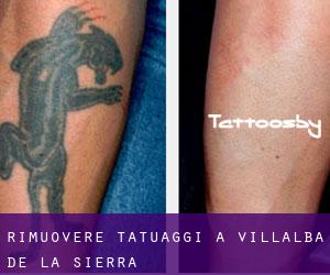 Rimuovere Tatuaggi a Villalba de la Sierra