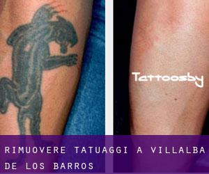 Rimuovere Tatuaggi a Villalba de los Barros