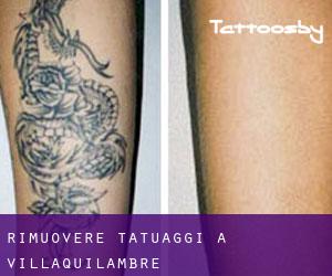Rimuovere Tatuaggi a Villaquilambre