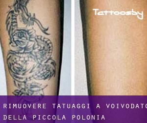 Rimuovere Tatuaggi a Voivodato della Piccola Polonia