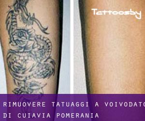 Rimuovere Tatuaggi a Voivodato di Cuiavia-Pomerania
