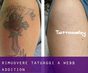 Rimuovere Tatuaggi a Webb Addition