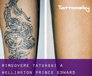 Rimuovere Tatuaggi a Wellington (Prince Edward Island)