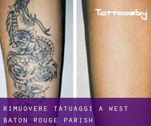 Rimuovere Tatuaggi a West Baton Rouge Parish