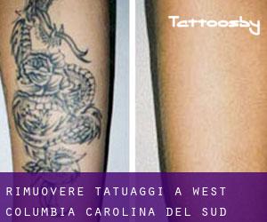 Rimuovere Tatuaggi a West Columbia (Carolina del Sud)