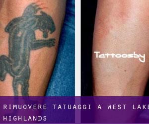 Rimuovere Tatuaggi a West Lake Highlands