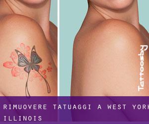 Rimuovere Tatuaggi a West York (Illinois)