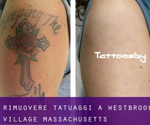 Rimuovere Tatuaggi a Westbrook Village (Massachusetts)