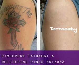 Rimuovere Tatuaggi a Whispering Pines (Arizona)