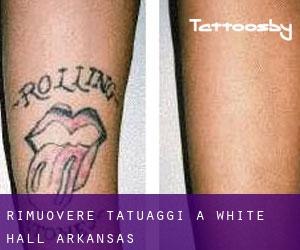 Rimuovere Tatuaggi a White Hall (Arkansas)