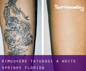 Rimuovere Tatuaggi a White Springs (Florida)
