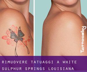 Rimuovere Tatuaggi a White Sulphur Springs (Louisiana)
