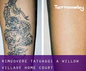 Rimuovere Tatuaggi a Willow Village Home Court