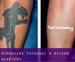 Rimuovere Tatuaggi a Wilson Quarters