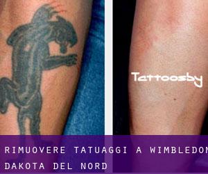 Rimuovere Tatuaggi a Wimbledon (Dakota del Nord)