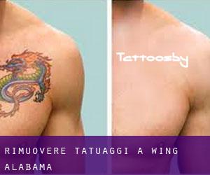 Rimuovere Tatuaggi a Wing (Alabama)