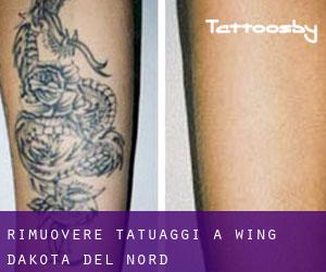 Rimuovere Tatuaggi a Wing (Dakota del Nord)
