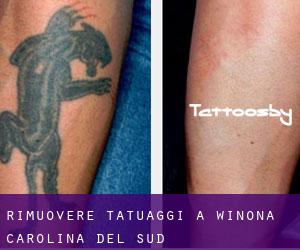 Rimuovere Tatuaggi a Winona (Carolina del Sud)