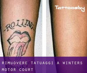 Rimuovere Tatuaggi a Winter's Motor Court