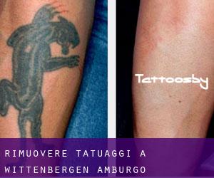 Rimuovere Tatuaggi a Wittenbergen (Amburgo)
