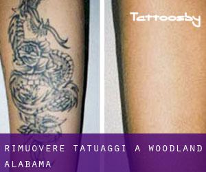 Rimuovere Tatuaggi a Woodland (Alabama)