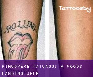 Rimuovere Tatuaggi a Woods Landing-Jelm