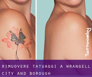 Rimuovere Tatuaggi a Wrangell (City and Borough)