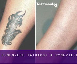 Rimuovere Tatuaggi a Wynnville