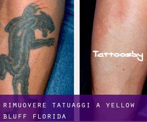 Rimuovere Tatuaggi a Yellow Bluff (Florida)