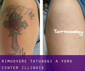 Rimuovere Tatuaggi a York Center (Illinois)