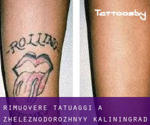 Rimuovere Tatuaggi a Zheleznodorozhnyy (Kaliningrad)