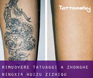Rimuovere Tatuaggi a Zhonghe (Ningxia Huizu Zizhiqu)