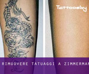 Rimuovere Tatuaggi a Zimmerman