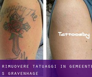Rimuovere Tatuaggi in Gemeente 's-Gravenhage